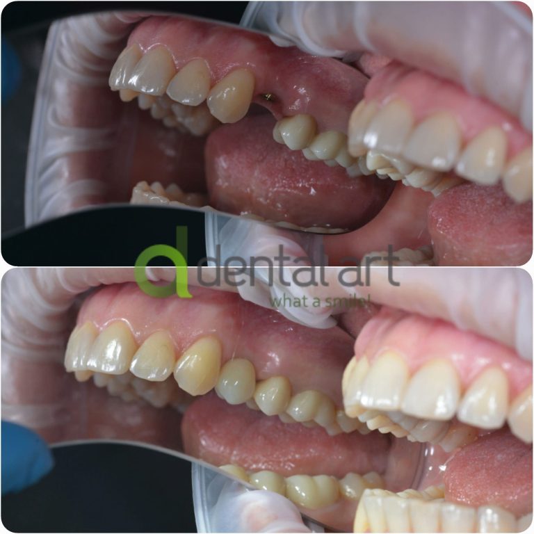 implant dentar dental art 1