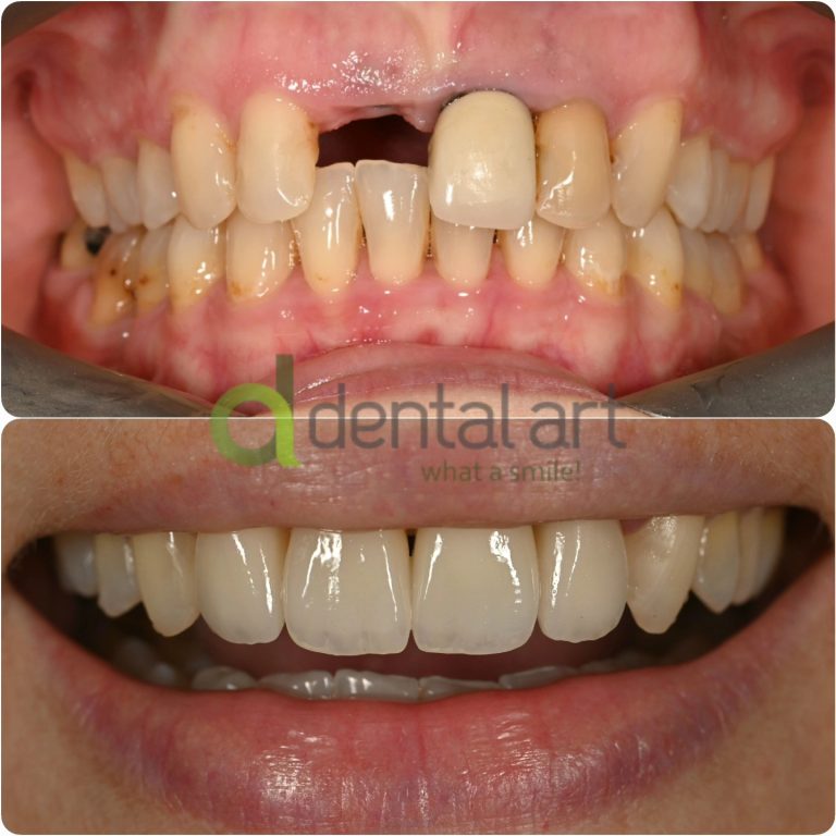 implant dentar dental art 2