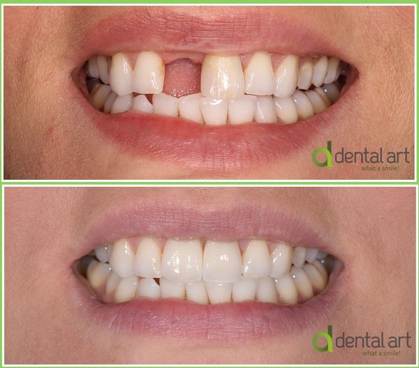 implant dentar dental art 3